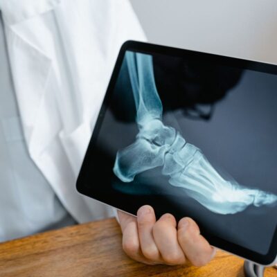 Recuperação após fratura instável